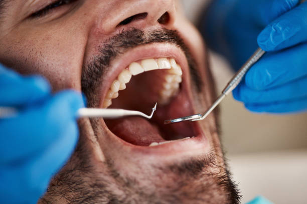 Best Root Canal Treatment  in Lake Nacimiento, CA